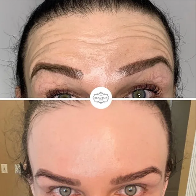 Anti-Wrinkle Injections before and after result