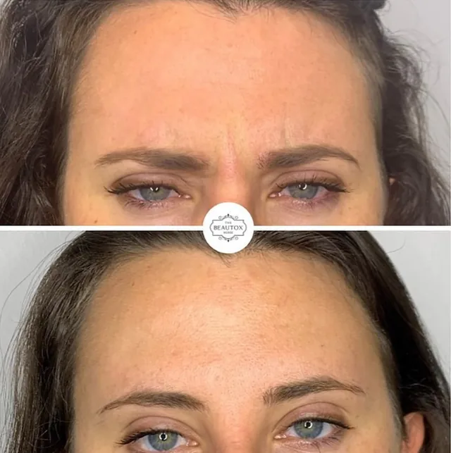 Anti-Wrinkle Injections before and after result