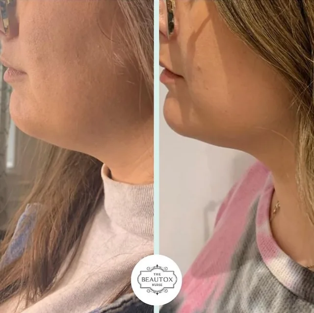 Fat Loss Injections before and after result