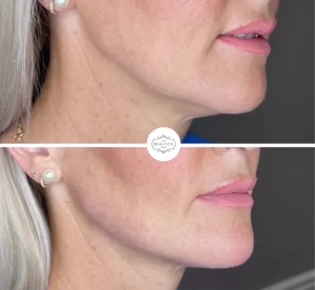 Dermal Fillers in Toronto & the GTA before and after result