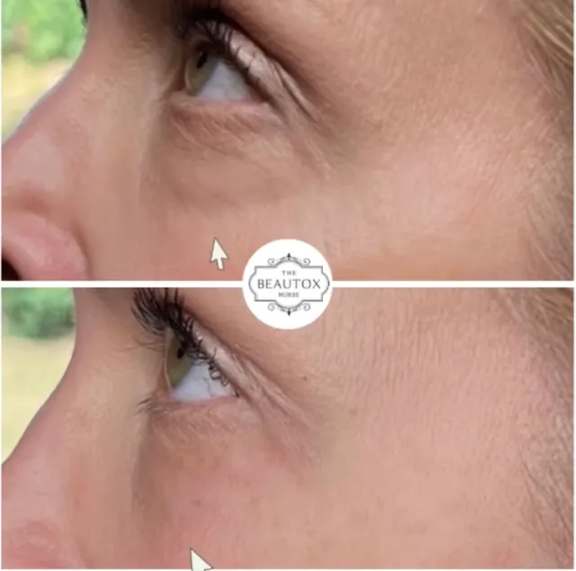 Dermal Fillers in Toronto & the GTA before and after result