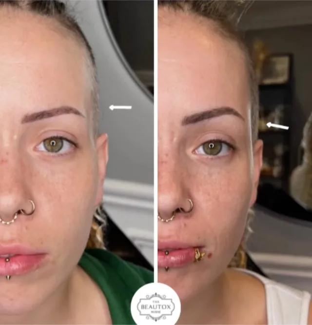 Dermal Fillers in Toronto & the GTA before and after result