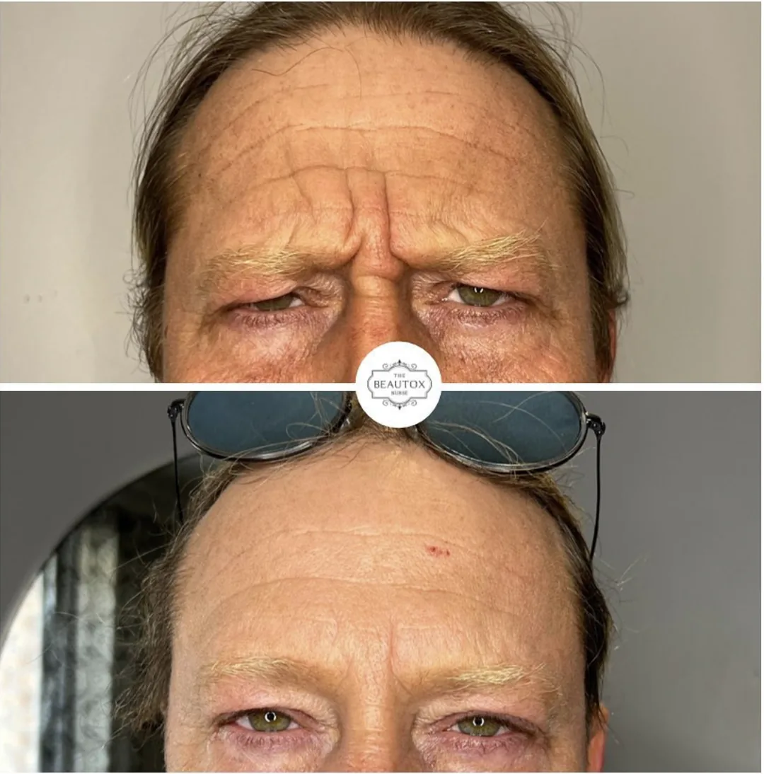 Anti-Wrinkle Injections