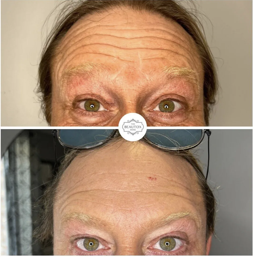 Anti-Wrinkle Injections