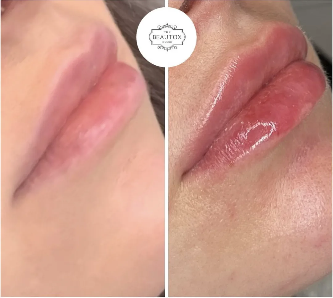 Dermal Fillers in Toronto & the GTA