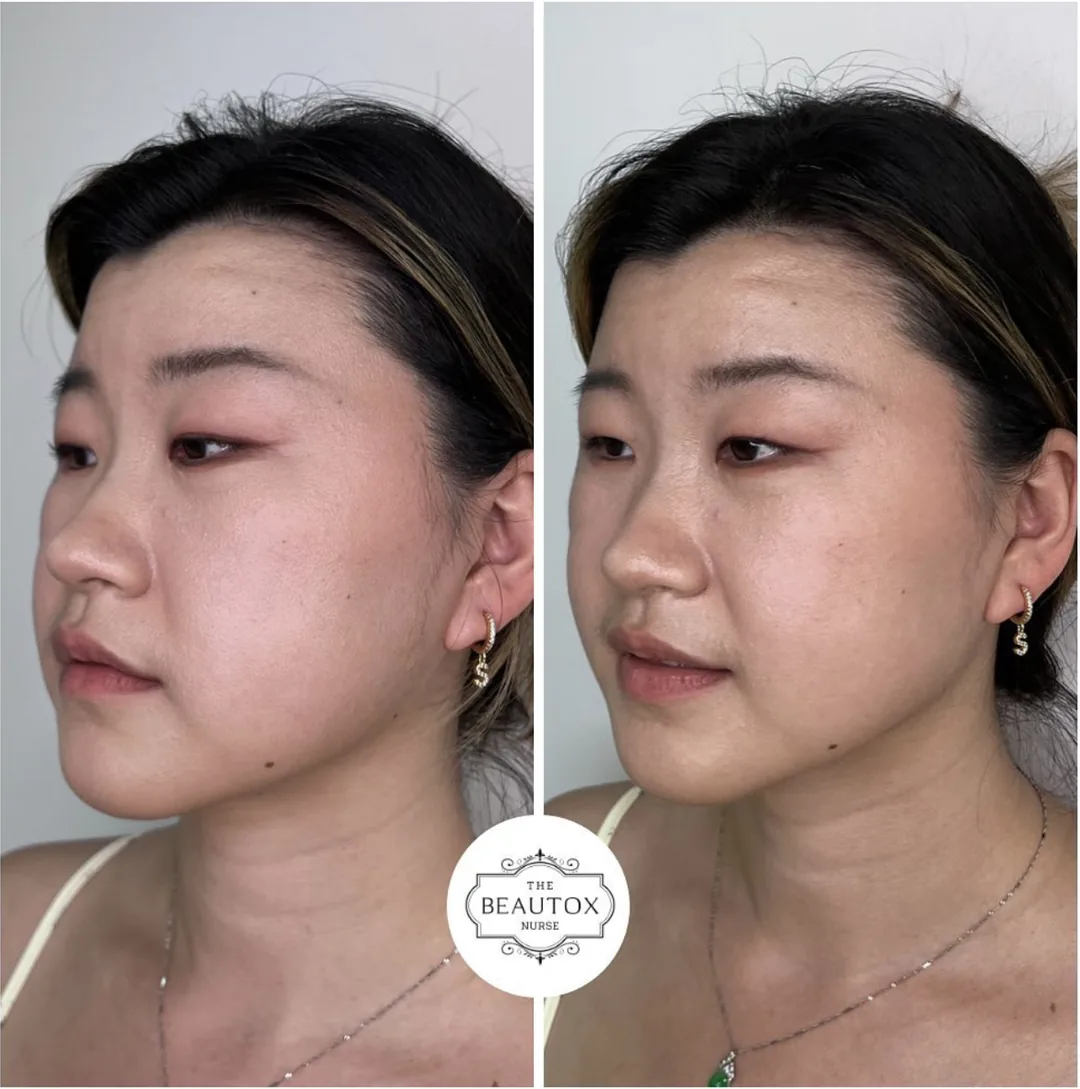 Dermal Fillers in Toronto & the GTA