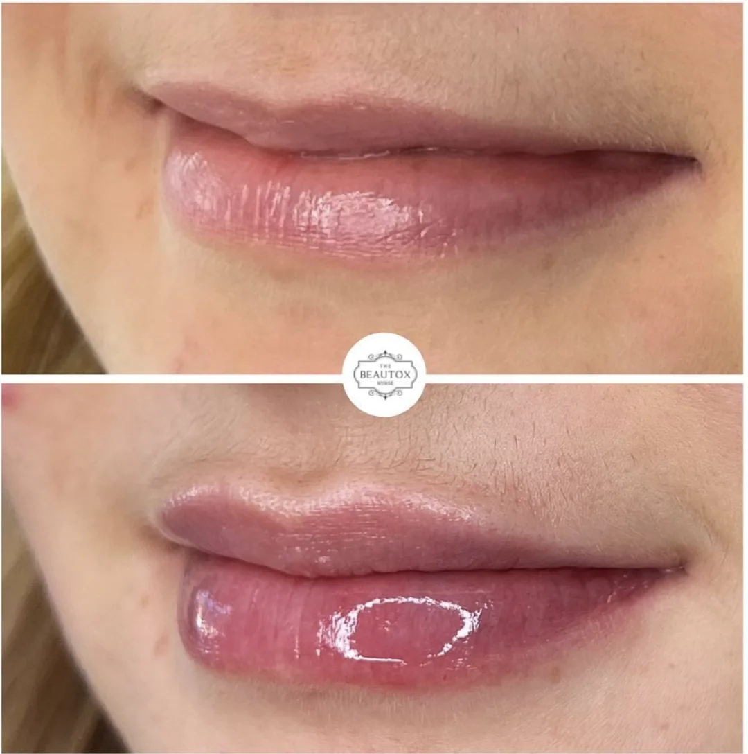 Dermal Fillers in Toronto & the GTA before and after result